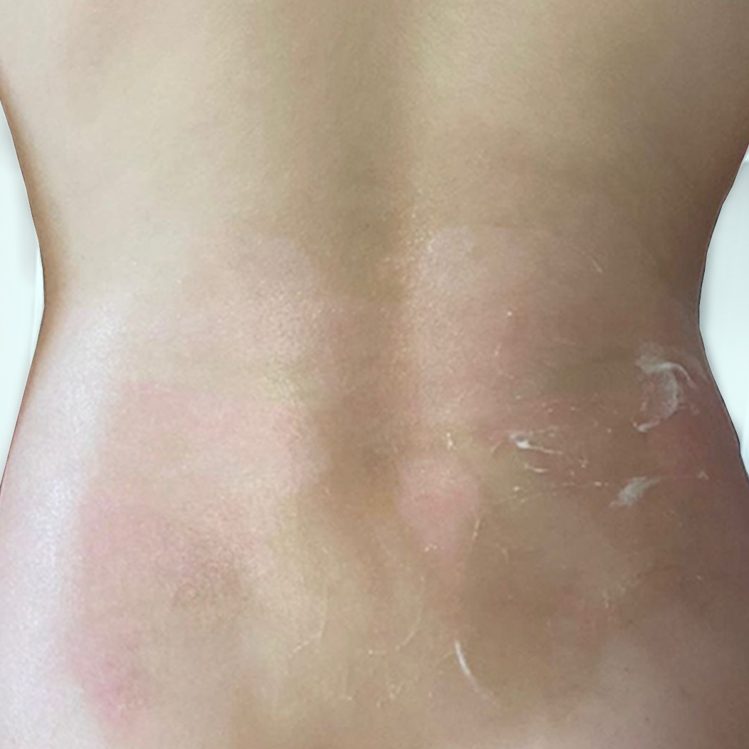 ket-qua-dieu-tri-dermalux