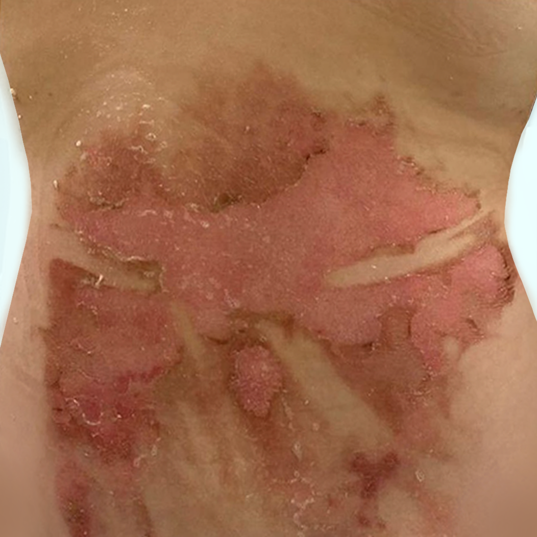 ket-qua-dieu-tri-dermalux