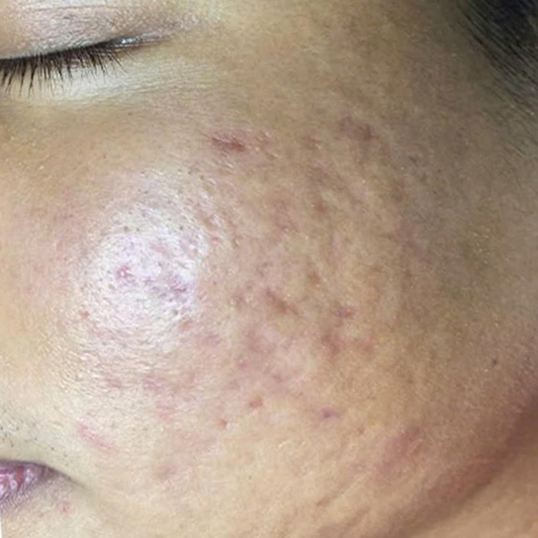 ket-qua-dieu-tri-dermalux