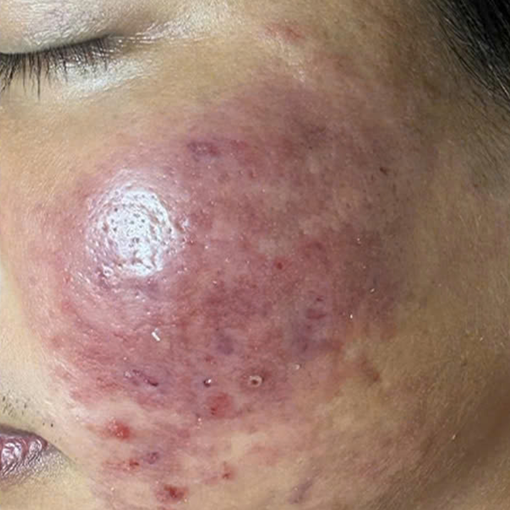 ket-qua-dieu-tri-dermalux