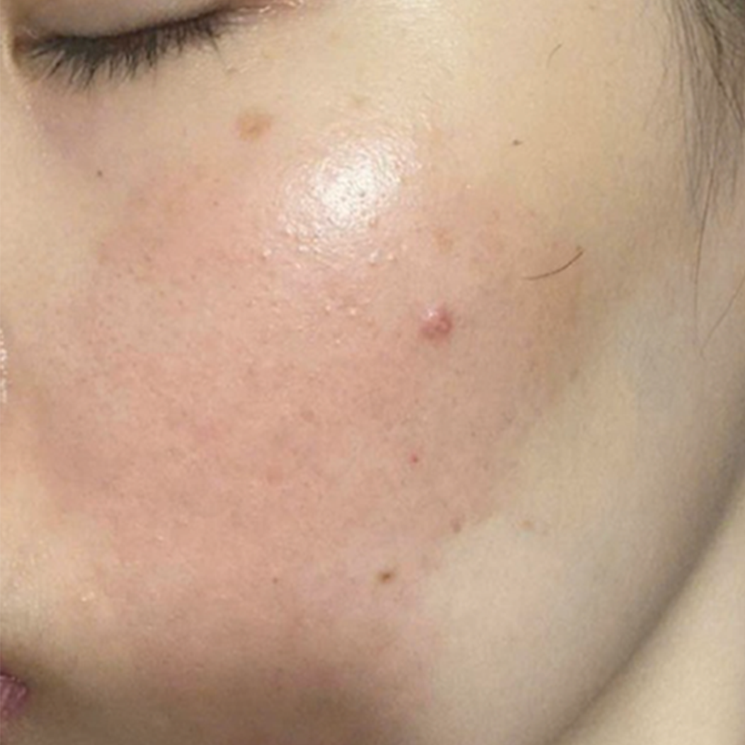 ket-qua-dieu-tri-dermalux