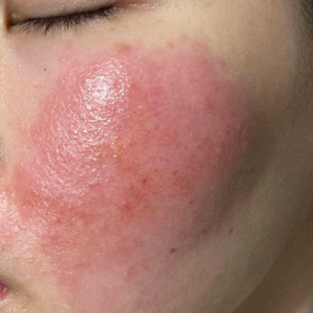 ket-qua-dieu-tri-dermalux