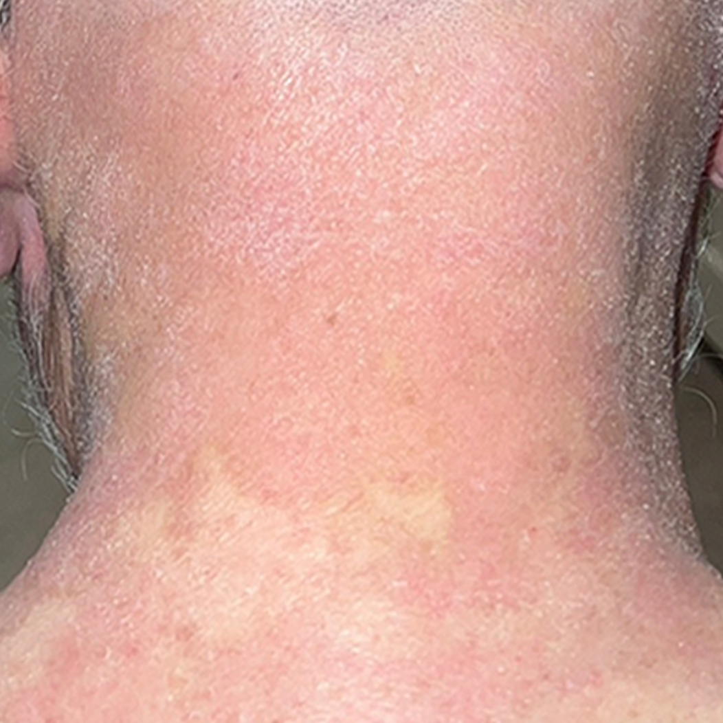 ket-qua-dieu-tri-dermalux