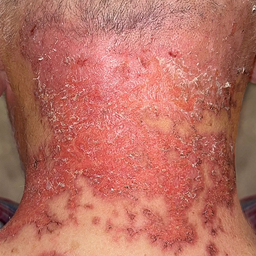 ket-qua-dieu-tri-dermalux