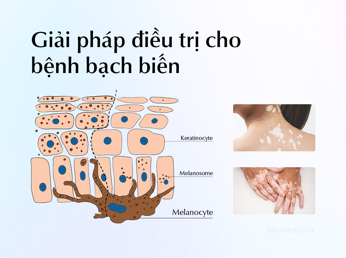 dieu-tri-benh-bach-bien