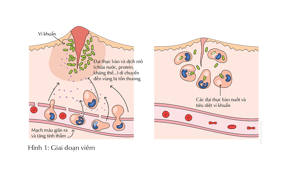 rut-ngan-giai-doan-viem-voi-dermalux
