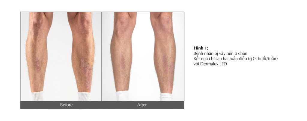 dermalux-trong-dieu-tri-vay-nen