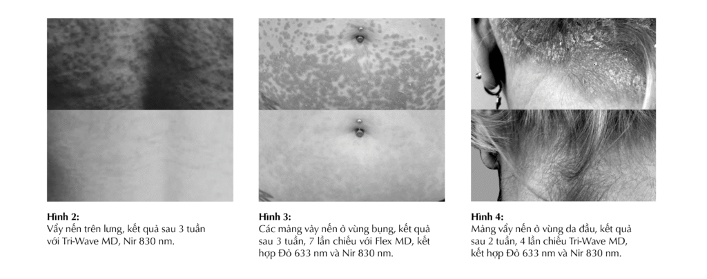 dermalux-trong-dieu-tri-vay-nen